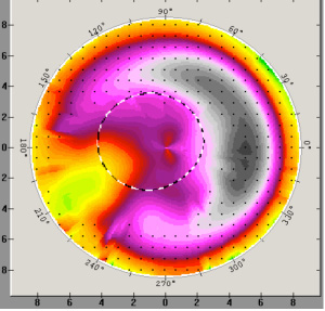 Keratoplastik