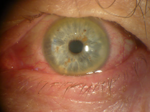 Conjunctivitis