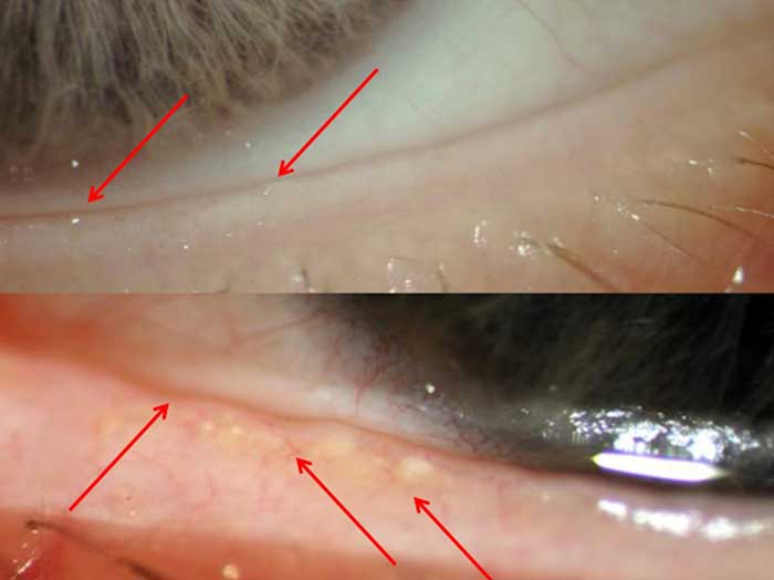 Sind die Lidkanten unregelmäßig, erscheinen sie eventuell sogar leicht aufgequollen und sind sie mit verästelten Blutgefäßen versehen, ist dies ein deutliches Zeichen für eine Dysfunktion der Meibomdrüsen