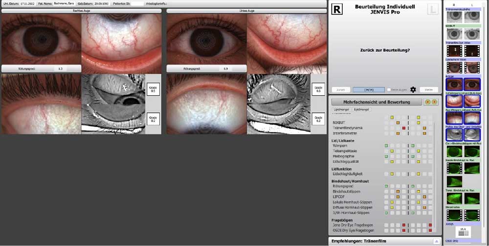 Abbildung 2: Darstellung der Lidkanten und Meibographie des Ober-und Unterlids und R-Scan beider Augen am Keratograph 5M mit JENVIS Pro Dry Eye Report