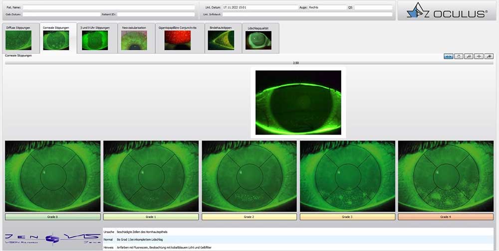 Abbildung 3: Graduierung der cornealen Epitheldefekte nach JENVIS Klassifikation am Keratograph 5M mit JENVIS Pro Dry Eye Report