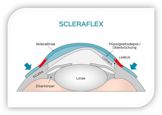 Sklerallinse